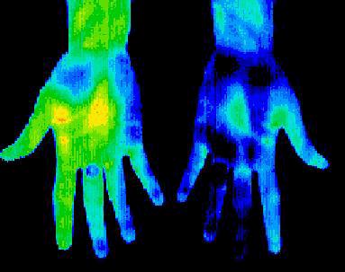 CRPS 2 rct + 7 observ + 9 cases 0.