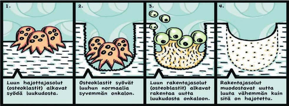 LUUSTOTERVEYS JA OSTEOPOROOSI Osteoporoosi ja osteopenia Osteoporoosi on luuston sairaus, jossa luun lujuus on alentunut, rakenne heikentynyt ja murtumariski lisääntynyt.